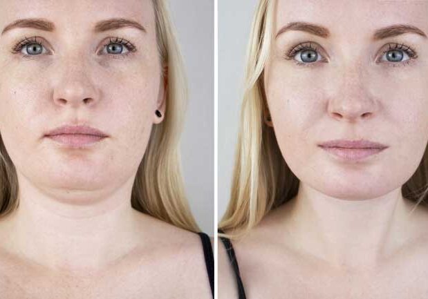 Weight loss injections in Lisburn & Belfast Northern Ireland